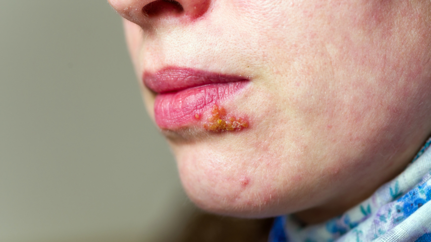 Vanligaste symtomen på munherpes är munsår med vätskefyllda blåsor. Foto: Shutterstock